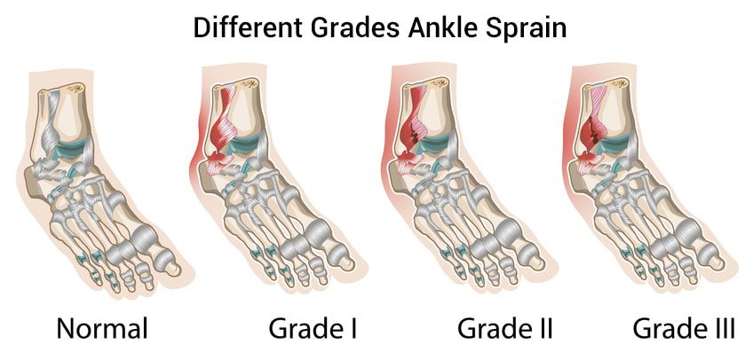 anklesprain1 - Ankle Sprains: Sprained ankle treatment and recovery time.