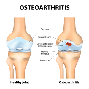 physiotherapy for osteoarthritis 1 - Using Physiotherapy for Osteoarthritis Treatment and Managing Joint Pain