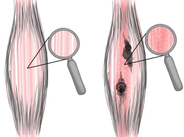 Fascial Tissue Adhesions - Tight Muscles? Try Myofascial Release Therapy in Brisbane