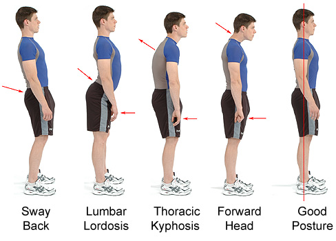 Posture Assessment - Poor Posture Assessments