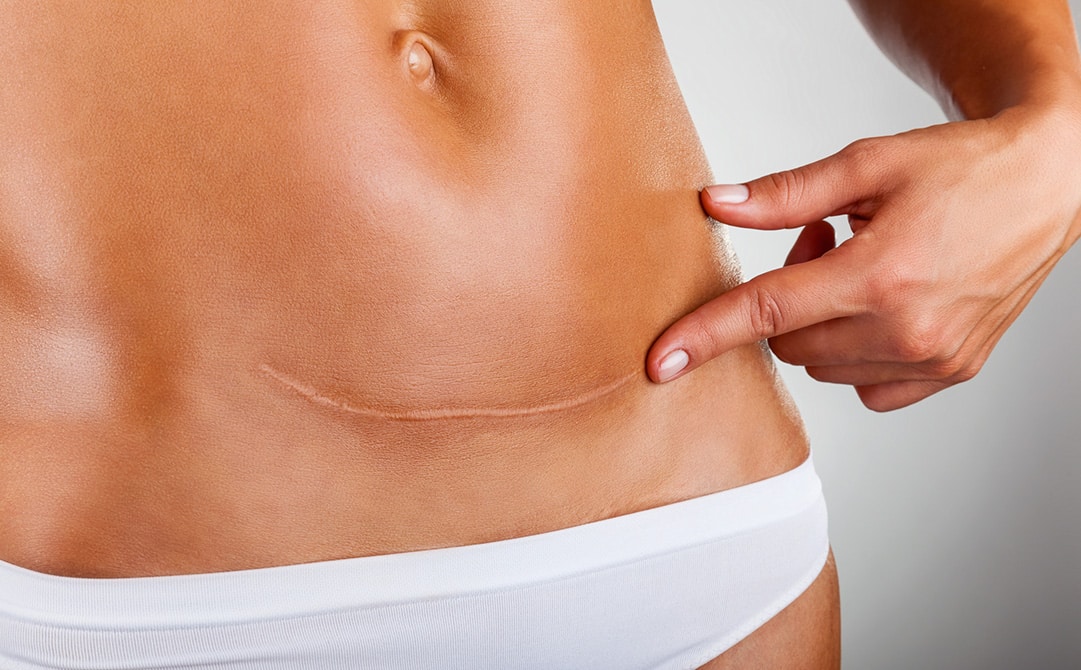 Abdominal Scar Treatment