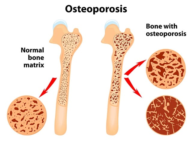 osteoporosis - Bone Health